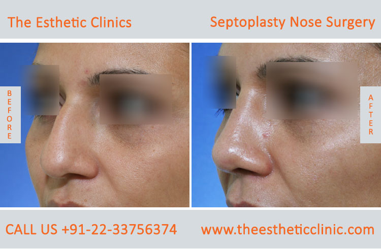 Septoplasty Nose Surgery before after photos in mumbai india (1)